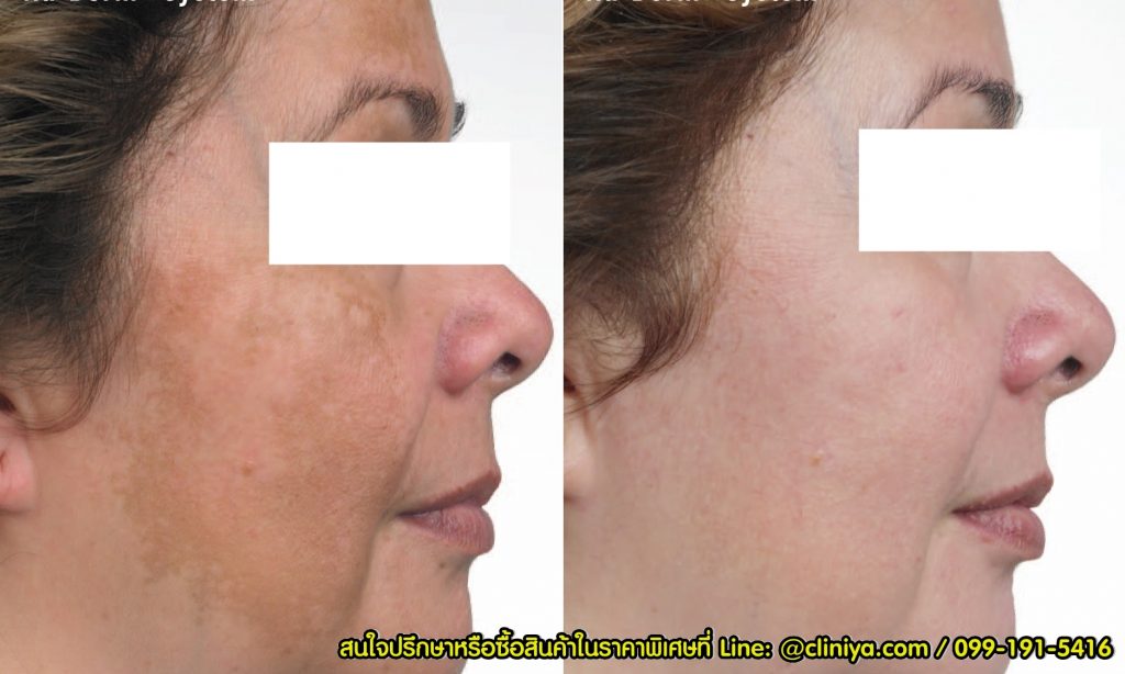 รีวิว ครีมทาฝ้า Expederm Tri-Action for Melasma with Melatrio