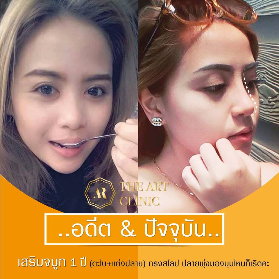 รีวิวเสริมจมูก หลังทำ 1 ปี ตะไบ+แต่งปลาย