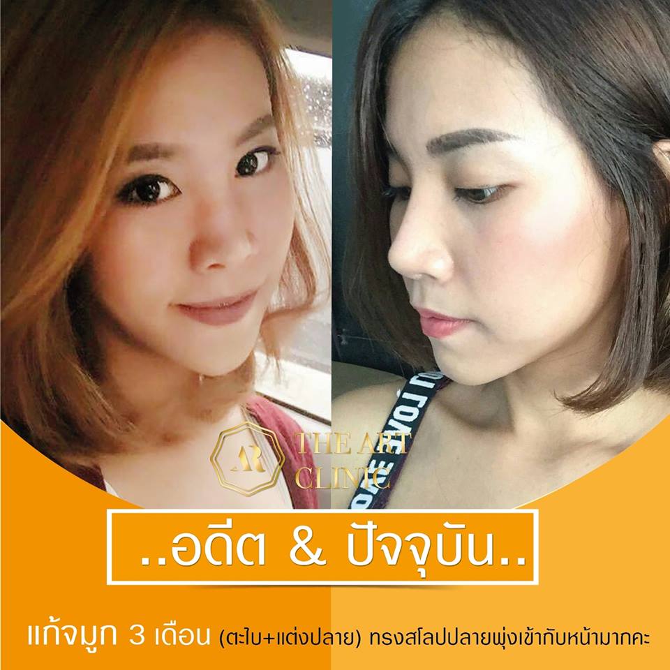 รีวิวแก้จมูก 3 เดือน ตะไบ+แต่งปลาย