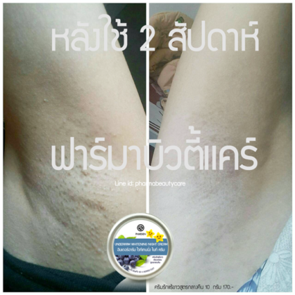 รีวิวครีมทารักแร้ขาว